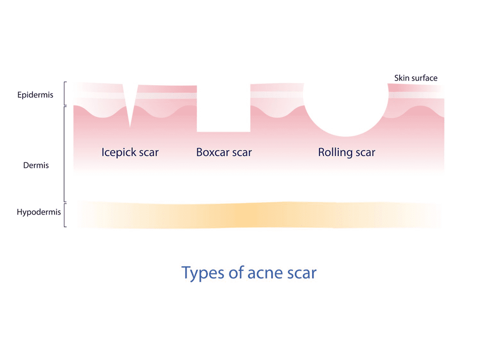 acne scar treatment in kokapet hyderabad