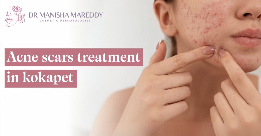 Acne scars treatment in kokapet
