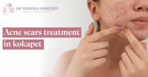 Acne scars treatment in kokapet
