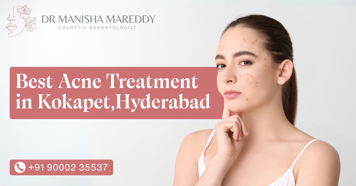 Best Acne Treatment in Kokapet