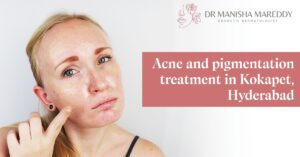 Acne and Pigmentation Treatment in Kokapet