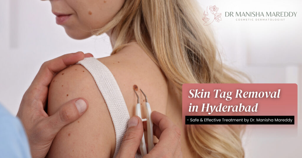 Skin Tag Removal Hyderabad – Safe Treatment by Dr Manisha