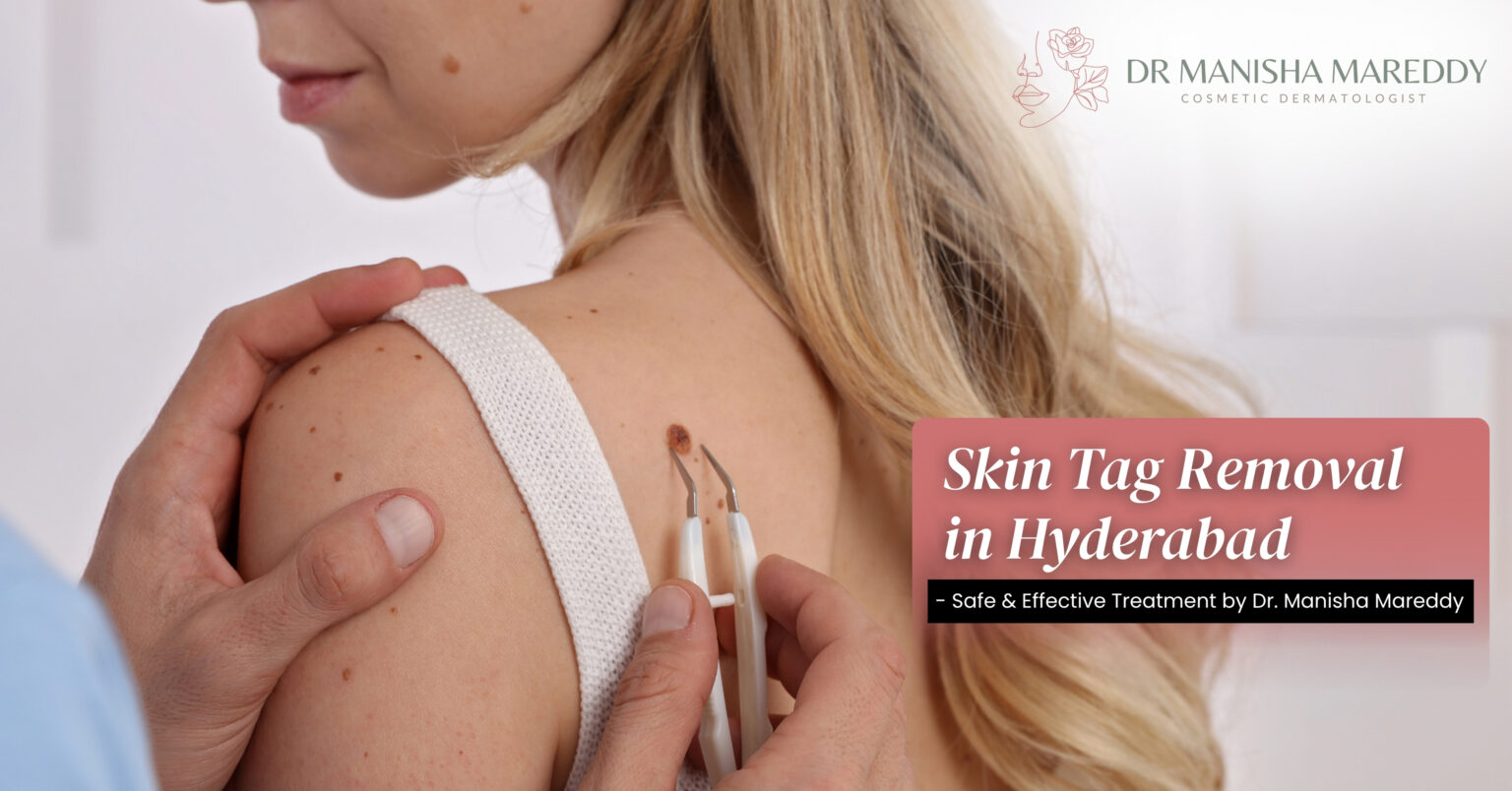 Skin Tag Removal Hyderabad – Safe Treatment by Dr Manisha